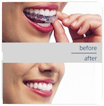 invisalign